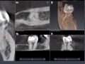 Using SICAT Endo To Help Diagnose C Shaped Canal