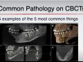 Top 5 Common Pathology Findings on CBCT