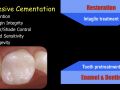 Simplified Adhesive Bonding Protocols for CEREC Restorations with Dr. Dennis Fasbinder