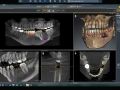 Surgical Treatment Planning in SICAT Implant 2.0
