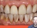 Tip of the Day - Correctly Preparing Anterior Teeth