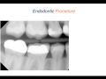 Endodontic Case 2 - Part 2 - Accessing Through Crown