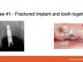 Implant Complications - Explant Cases