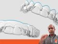 Tip of the Day - Trim Line For Aligners