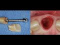 Digital Implant Dentistry Strategies to Treat the Hopeless Tooth Esthetic Zone - Part 1