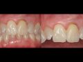 Digital Implant Dentistry Strategies to Treat the Hopeless Tooth Esthetic Zone - Part 2