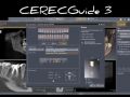 Sleeve Height with CEREC Guide 3