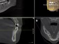 How To Use Endo Tab Within 3D Software to Evaluate Tooth Prior to RCT