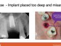 Implant Complications - Non Restorable Placement