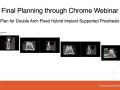 Full Arch Case - Chrome Full Arch Implant Workflow
