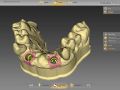 10. inLab 20 Abutments - Creating Implant Model