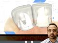 Tip of the Day - Troubleshooting Custom Abutments