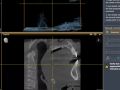 How To Use Your CBCT to Screen for Sleep Apnea