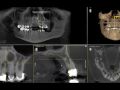 Evaluating a Tooth Prior to Endodontic Treatment