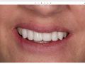 Comprehensive Anterior Case - Smile Consultation with Patient
