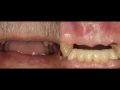 Immediate Implant Placement Fixed Partial Denture