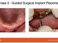 Edentulous Full Arch Implant Planning - Part 3 - Guided Implant Placement