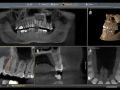 Using CBCT To Help During Today's Endodontic Procedure