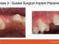 Placing Implants through Cuspids - Part 3 - Guided Implant Placement