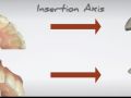 Insertion Axis and Its Effect