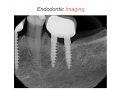 Endodontic Case 19 - Difficult Mandibular Premolar - Diagnosis