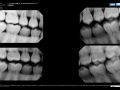 CBCT Assists in Diagnosing Carious Lesions