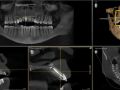 Tooth 9 2D vs 3D imaging