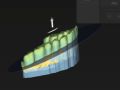 Splint Design Using Open Jaw Feature 2