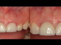 Achieving Correct Gingival Margin Position Part 1