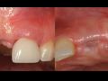 Achieving Correct Gingival Margin Position Part 2