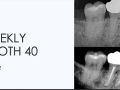 Week 2 - Weekly Tooth 40