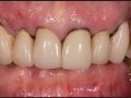1. Introducing Problem with Upper Complete Immediate Denture