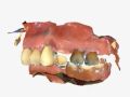 2. Building Up Lower Partial Denture
