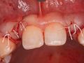 Site Prep Grafting for Congenitally Missing Lateral Incisors
