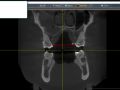Reviewing CBCT with Airway