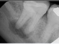 Weekly Tooth 40 - Not Convinced it's a Fracture?