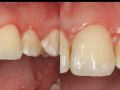 Implant Therapy in Impacted Canine Site