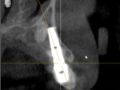 CDOCS Case Implant Near an Impacted Cuspid