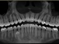 CDOCS Case Video on Supernumerary Teeth
