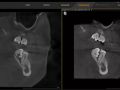 Comparing 3M's Over Time with CBCT