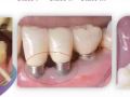 Lesson 5 - Should We Scale A Dental Implant