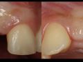 Congenitally Missing Lateral Incisor