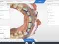 Prep and Insertion Axis for Veneers Importance