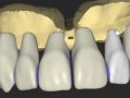 Reference Denture 5 - Mophology and Positioning
