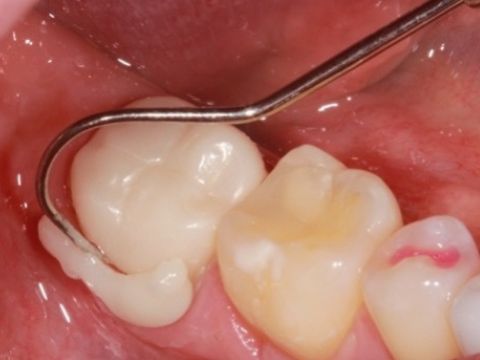 The Chairside Zirconia Revolution: The Evolution of Choice