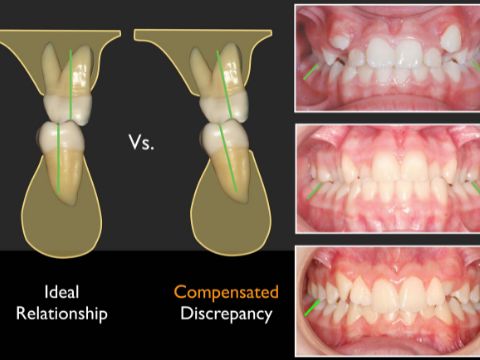 Transverse Considerations in Periodontal Attachment Loss