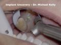 Solea Implant Uncovery #14 - Dr. Michael Kelly