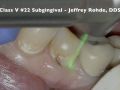 Class V #22 (Subgingival) - Dr. Jeffrey Rohde