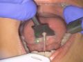 Solea Lingual Frenectomy - Dr. Lawrence Kotlow
