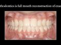 Clear Aligner Limitations and Tooth Movement